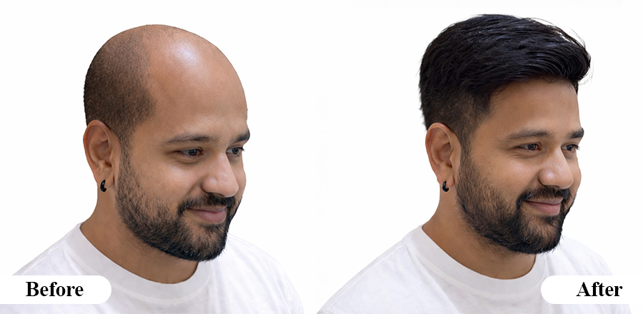 Men's Patch Hyderabad
